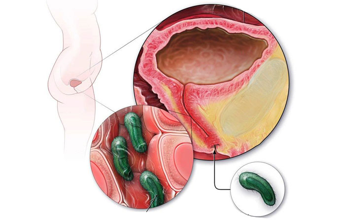 Viêm bàng quang do các loại vi khuẩn gram âm gây viêm vùng niêm mạc