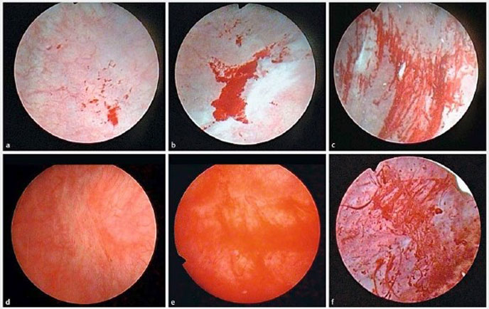 Viêm bàng quang xuất huyết, một dạng biến chứng gây chảy máu ngay tại vị trí tổn thương niêm mạc
