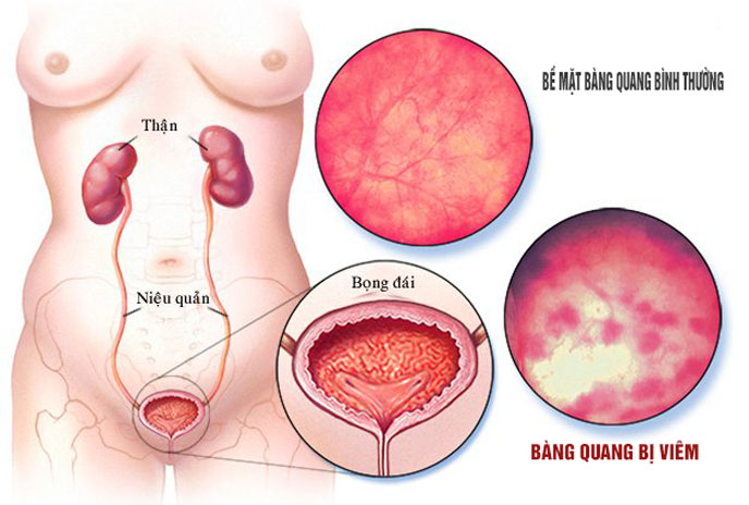 Viêm bàng quang cấp là gì? Biến chứng nguy hiểm cần nhận biết sớm