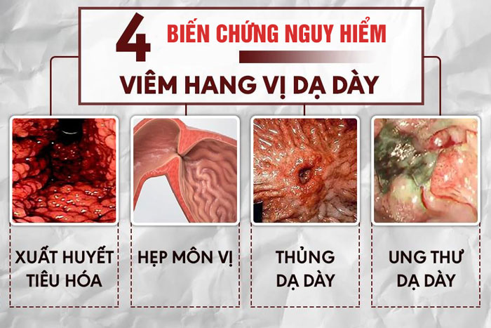 Viêm xung huyết hang vị dạ dày cần lưu ý