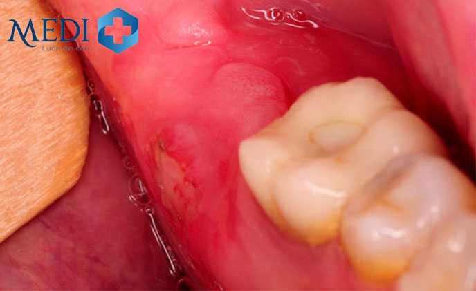 Viêm lợi là nguyên nhân gây chảy máu chân răng phổ biến