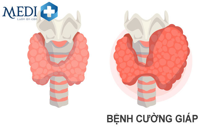 Cường giáp do nhiều nguyên nhân gây nên