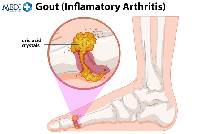 Bệnh Gout do lắng đọng tinh thể urat ở các mô
