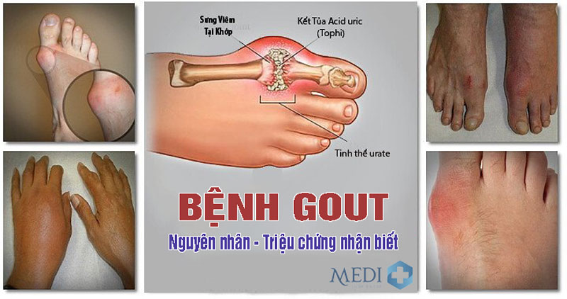 Bệnh gout (gút) là gì? Các triệu chứng biểu hiện bị gút