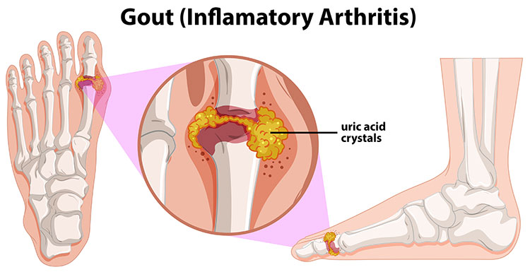 Bệnh Gout gây nên những cơn đau khớp trầm trọng và dữ dội