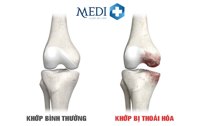 Thoái hóa khớp là tình trạng tổn thương tại phần sụn khớp