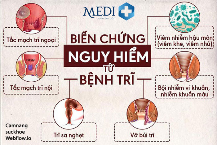 Biến chứng nguy hiểm của bệnh trĩ