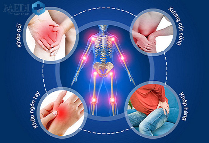 Thoái hóa khớp thường xảy ra ở khớp gối, khớp háng, ngón tay, cột sống