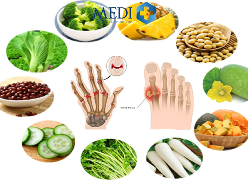 Hình ảnh bệnh gout và cách phòng tránh bệnh gout 