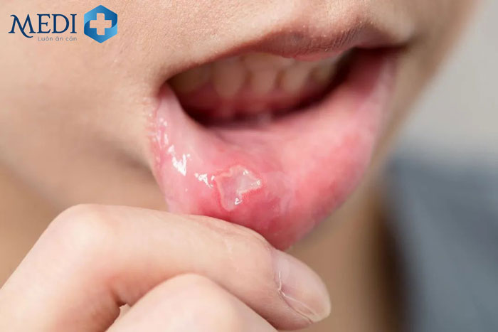 Bố mẹ cần xác định đúng nguyên nhân gây bệnh để theo dõi và điều trị loét miệng ở trẻ 
