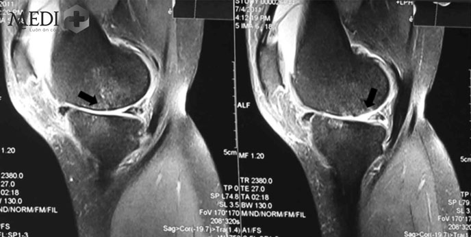 Hình ảnh chụp MRI (cộng hưởng từ) thoái hóa khớp gối