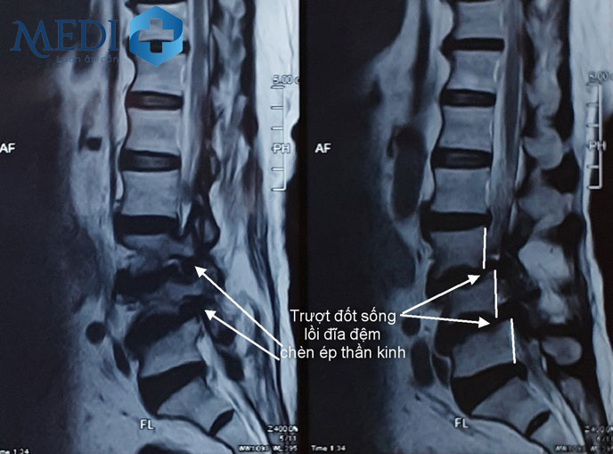 Chụp X - quang là cách đơn giản nhất giúp chẩn đoán thoát vị đĩa đệm một cách chính xác.