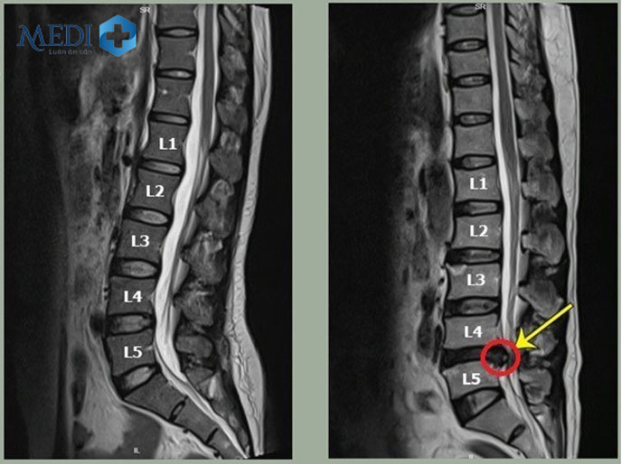 Tiến hành phẫu thuật điều trị thoát vị đĩa đệm L4 L5 có thể được các bác sĩ chỉ định.