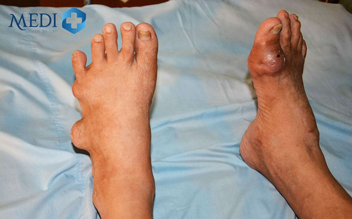 Bệnh gout giai đoạn 4 hình thành các nốt tophi và khớp bị biến dạng