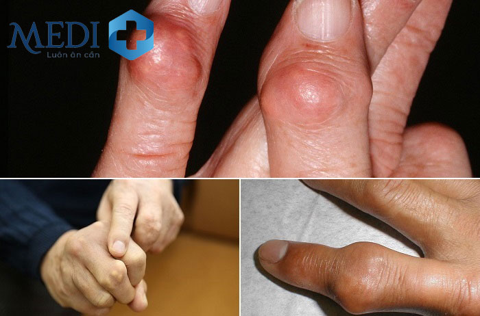 Bệnh gout giai đoạn 4 hình thành các nốt tophi và khớp bị biến dạng