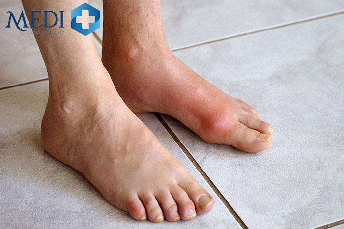 Đợt gout cấp tính biểu hiện bằng các khớp sưng, nóng và đỏ