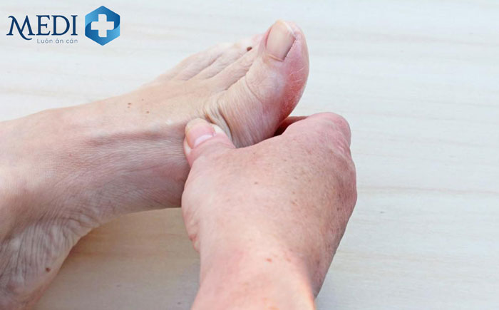Bệnh gout ở giai đoạn 1 chỉ có thể phát hiện qua xét nghiệm nồng độ acid uric trong máu