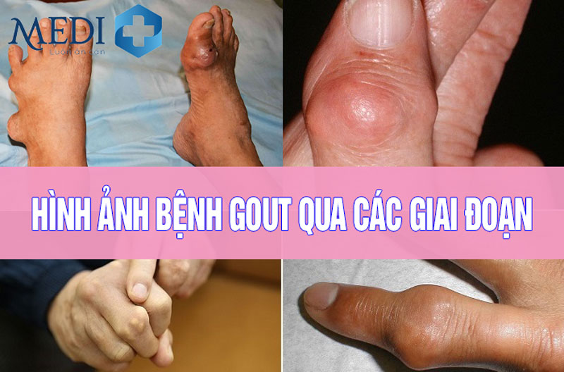 Hình ảnh bệnh gout và cách phòng tránh bệnh gout 