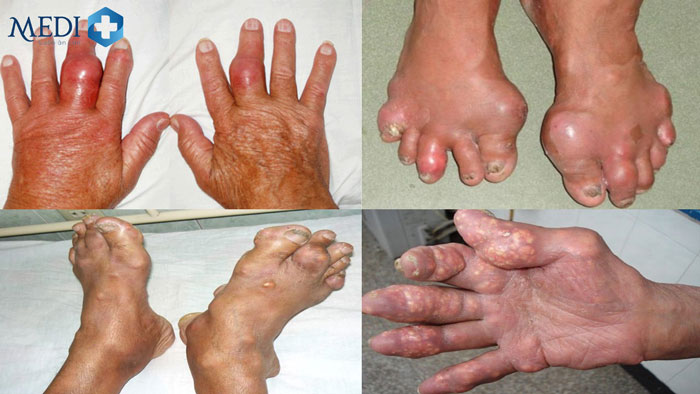 Bệnh gout ngày càng trở nên phổ biến và trẻ hóa