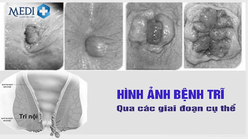 Hình ảnh bệnh trĩ (trĩ nội, trĩ ngoại) ở các giai đoạn cụ thể