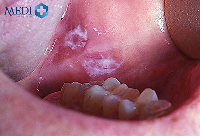 Hình ảnh sùi mào gà giai đoạn đầu với các vết viêm trong khoang miệng