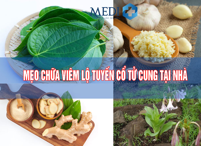 Mẹo chữa viêm lộ tuyến cổ tử cung tại nhà đơn giản và hiệu quả