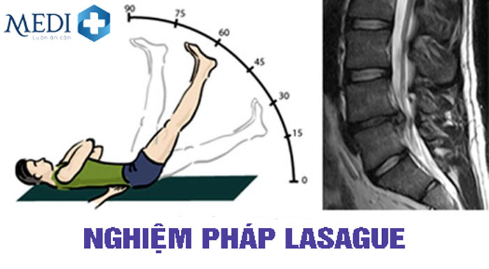 Nghiệm pháp Lasegue khám lân sàng hội chứng thắt lưng