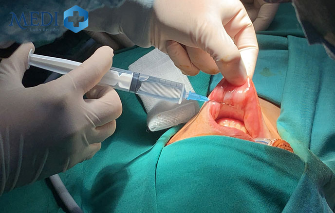 Phẫu thuật nội soi tuyến giáp đường miệng (Hình ảnh tiêm gây tê niêm mạc)