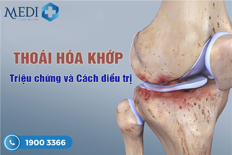 Thoái hóa khớp là gì (Osteoarthritis – OA) Cách điều trị hiệu quả