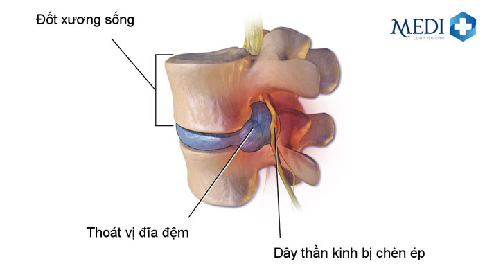 Hình ảnh đĩa đệm thoát vị chèn ép dây thần kinh gây đau nhức.