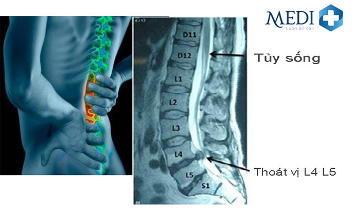 Thoát vị đĩa đệm thắt lưng L4 L5 là vị trí hay gặp