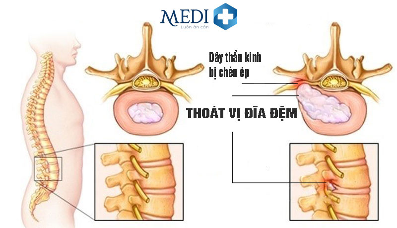 Thoát vị đĩa đệm: Nguyên nhân, triệu chứng, chẩn đoán và điều trị