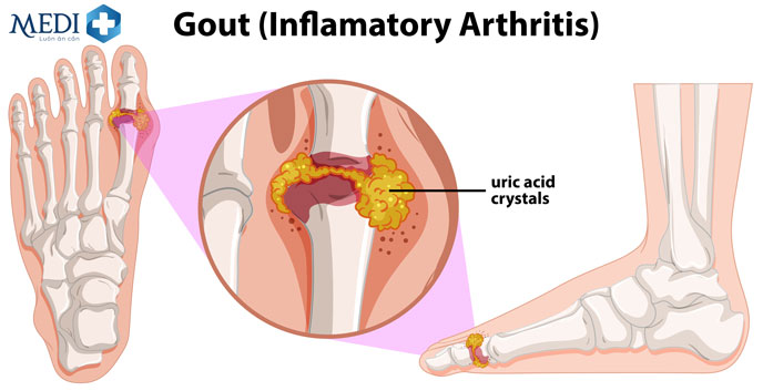 Các tinh thể urat kết tủa trong và xung quanh khớp, gây nên viêm khớp