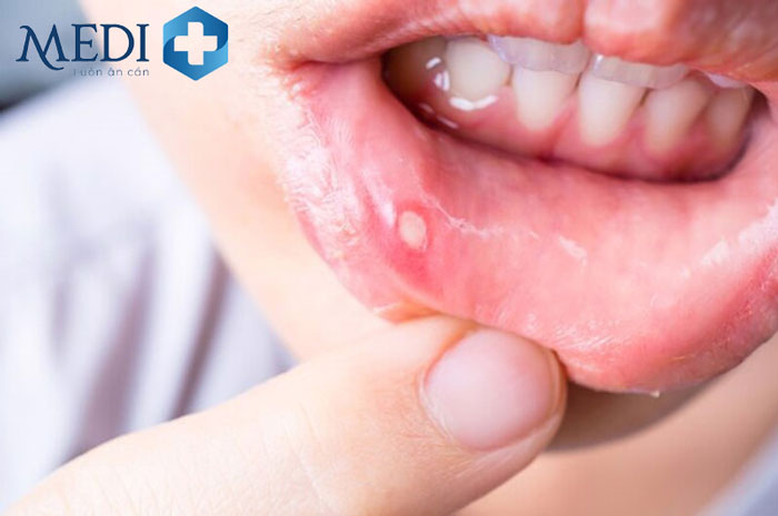 Loét miệng ở trẻ có thể là biểu hiện của nhiều bệnh lý nguy hiểm