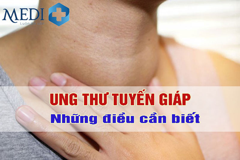 Bệnh ung thư tuyến giáp – Những điều cần phải biết sớm