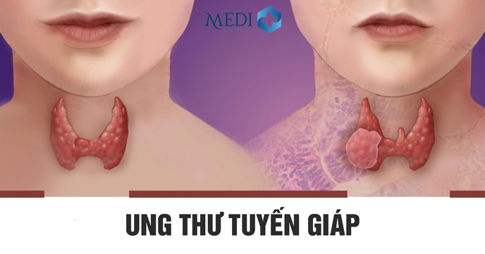 Ung thư tuyến giáp do tăng bất thường các tế bào tuyến giáp