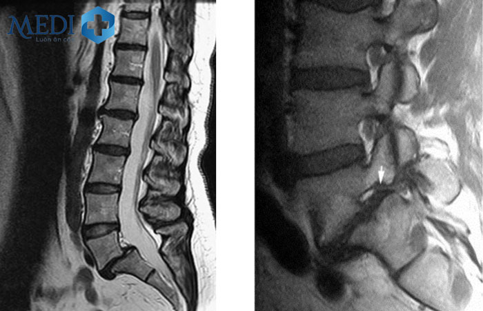 Chụp x quang chẩn đoán các vấn đề cột sống thắt lưng một cách chính xác hơn.