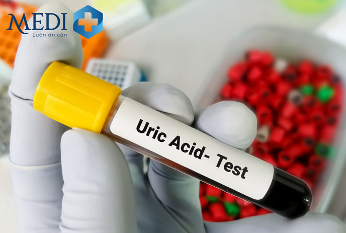 Xét nghiệm nồng độ acid uric máu thường được chỉ định cho người bệnh Gout