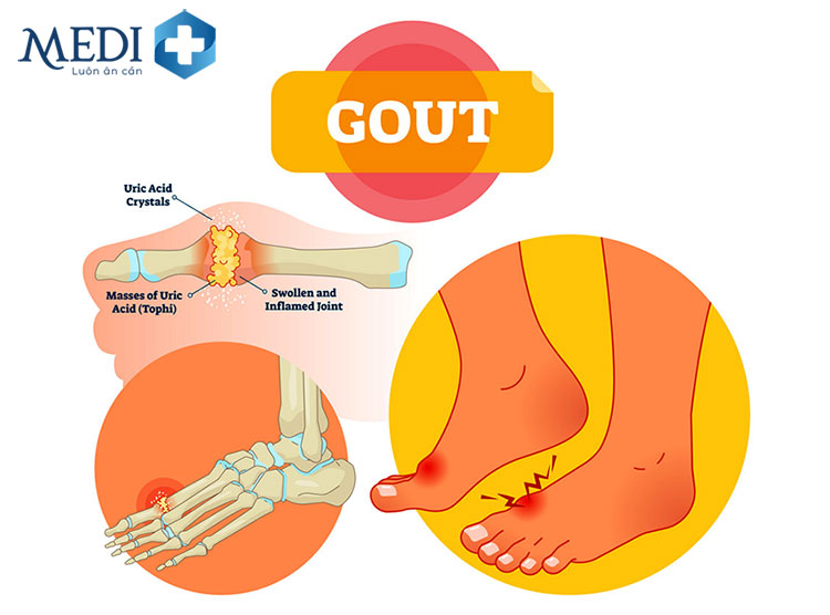 Bệnh gout có chữa được không là thắc mắc của rất nhiều người