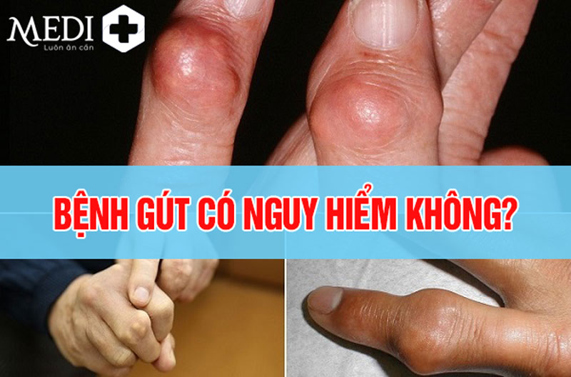 Bệnh gút có nguy hiểm không? [Bác sĩ GIẢI ĐÁP]