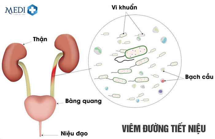 Bựa sinh dục chứa nhiều vi khuẩn có thể là nguyên nhangaya viêm đường tiết niệu