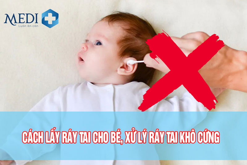 Cách lấy ráy tai cho bé, xử lý ráy tai khô và vón cục