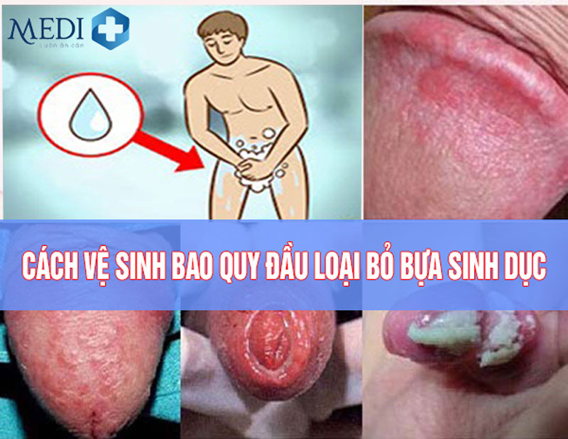 Cách vệ sinh bao quy đầu loại bỏ bựa sinh dục