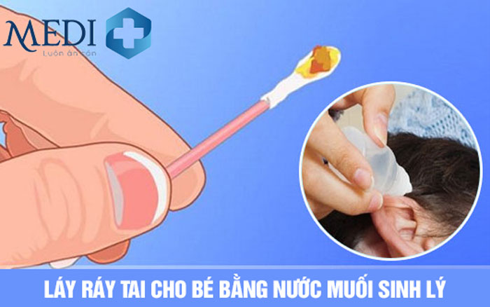 Dùng nước muối sinh lý loãng giúp làm mềm ráy tai để dễ dàng lấy ra