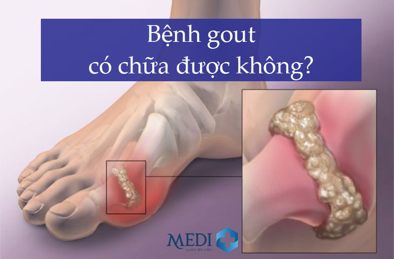 Bệnh gout có chữa được không? Chuyên gia giải đáp