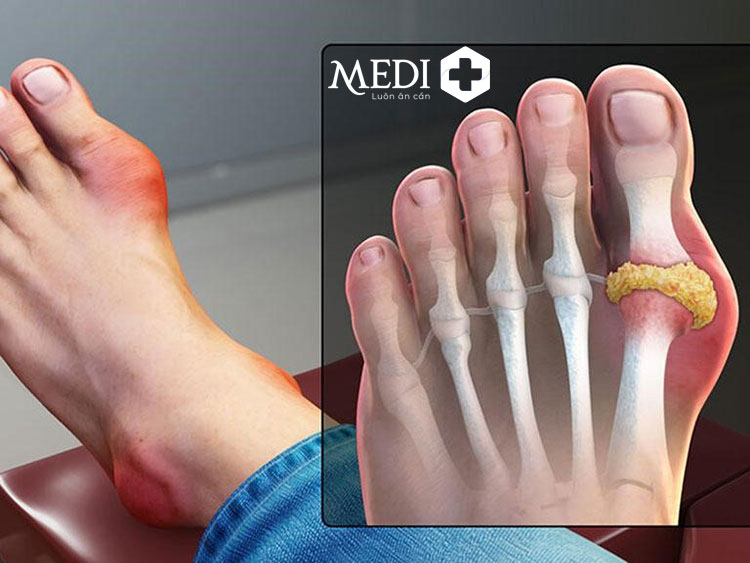 Mức độ nguy hiểm của gout tùy vào giai đoạn và tình trạng bệnh