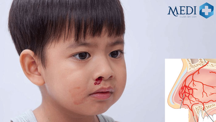 90% trường hợp chảy máu mũi là do tổn thương các mạch máu bên trong