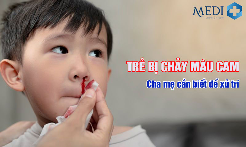 Trẻ bị chảy máu cam (chảy máu mũi) Cha mẹ cần biết