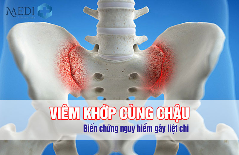 Viêm khớp cùng chậu: Nguyên nhân và hướng điều trị hiệu quả