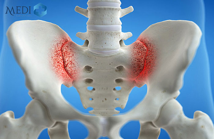 Viêm khớp cùng chậu thường gây đau ở vùng xương cụt, đùi, mông, lưng dưới,...